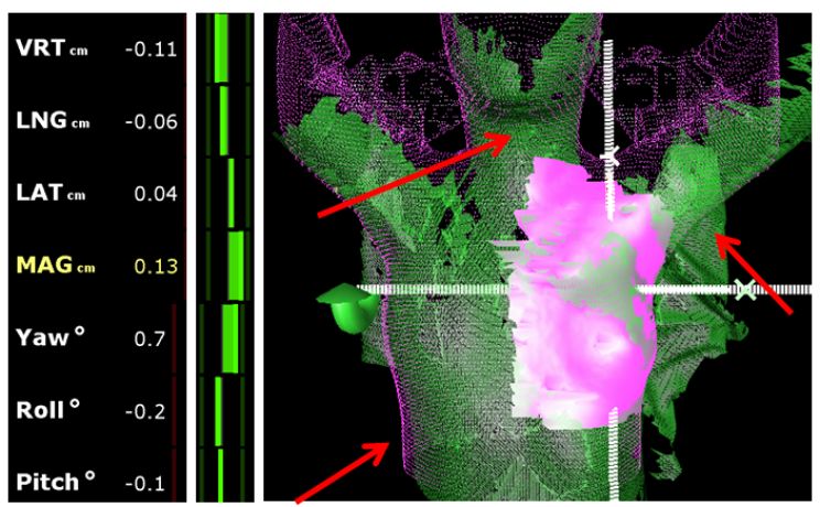 Software waarbij in kleur en getal het verschil in positie met de plannings - CT wordt weergegeven 